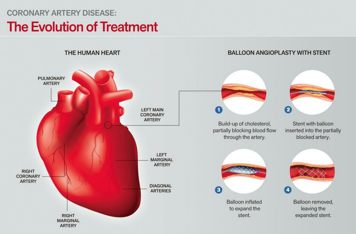 The Evolution Of Treating Heart Conditions - St. Clair Hospital