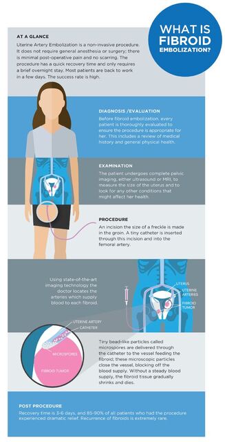 What Are Uterine Fibroids and How Do You Treat Them? - St. Clair Hospital